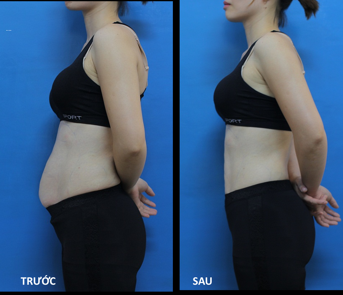  máy massage bụng điều chỉnh MG 2022